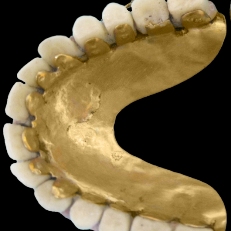 Dentures with gold alloy base and porcelain teeth, courtesy of the National Museum of Dentistry